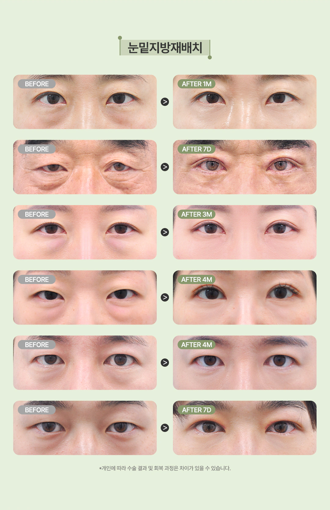 올로 눈밑지방재배치 전후 사례, 개인에 따라 수술 결과와 회복 과정은 다를 수 있습니다