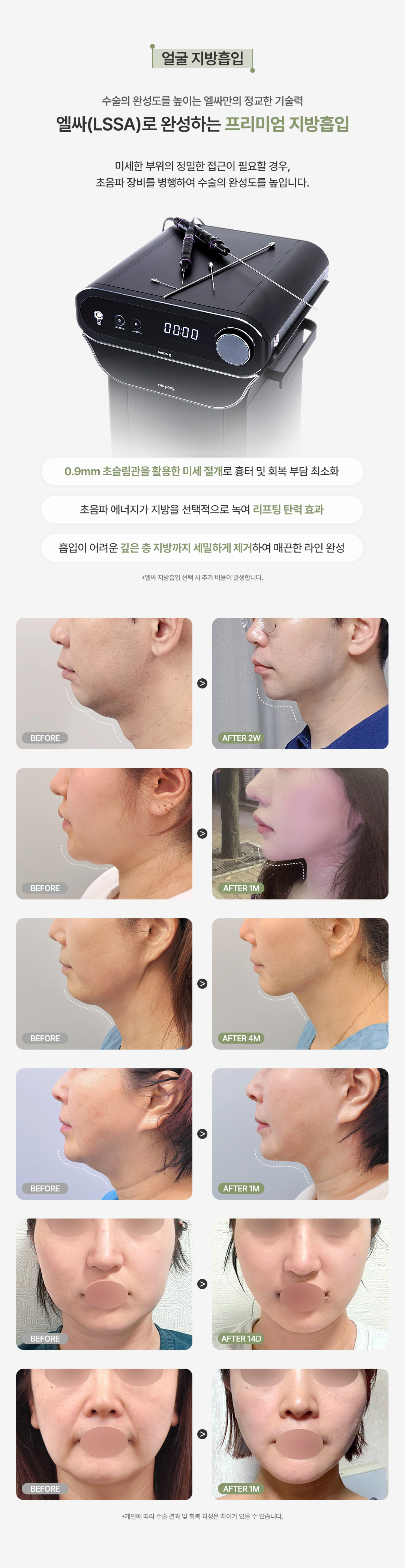 올로 얼굴 지방흡입 안내와 전후 사례, 개인에 따라 수술 결과와 회복 과정은 다를 수 있습니다